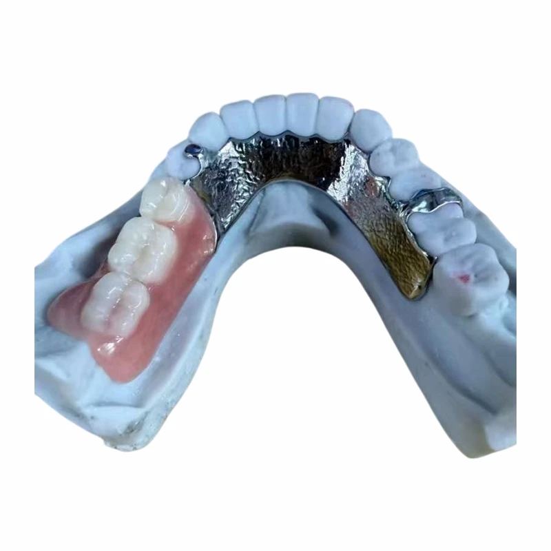 Vitallium metal chapant ak yon pati nan dan Acrylic